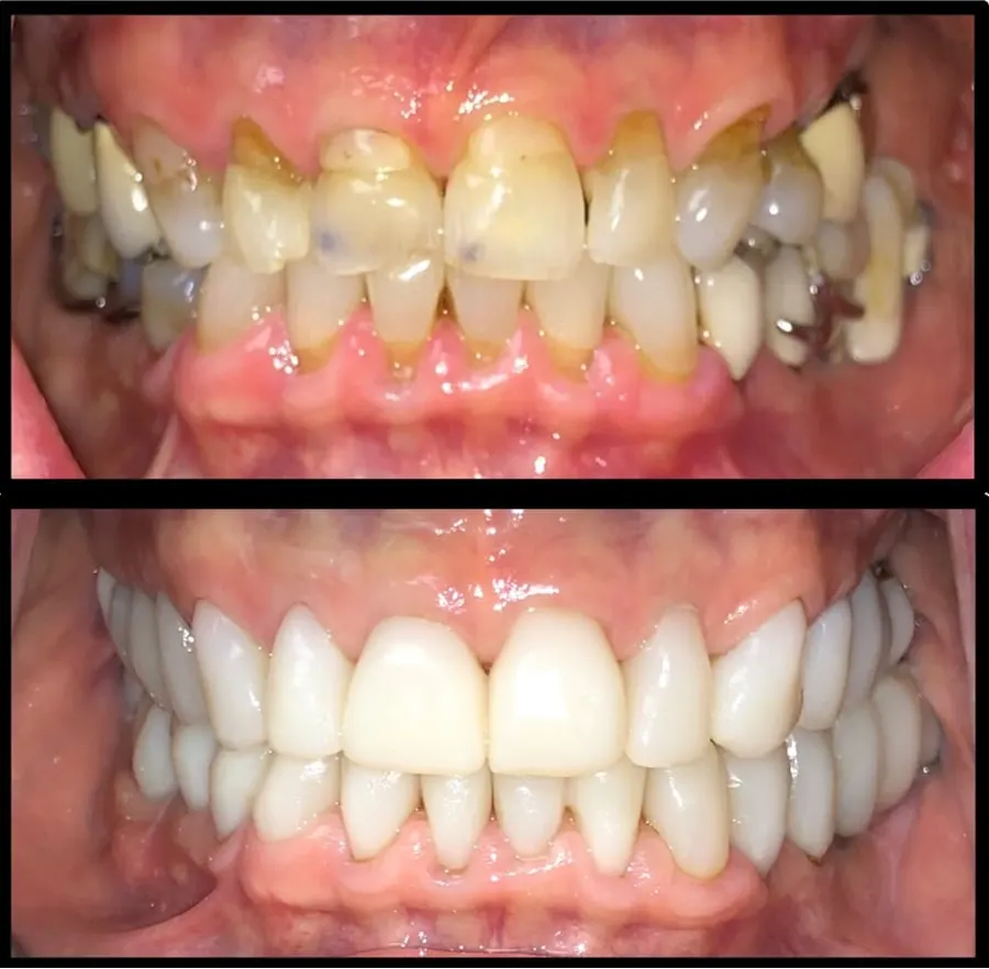 Full mouth restoration before and after